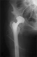 Röntgenbild Hüftprothesenimplantation