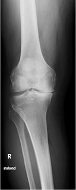 Röntgenbild Knorpelschaden am Kniegelenk