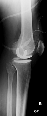 Röntgenbild Kniegelenk mit Schlittenprothese (Seitenansicht)