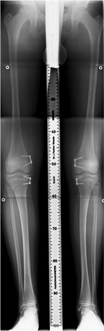 Röntgenbild: Korrektur von X-Beinen