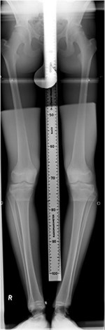 Röntgenbild einer Kniefehlstellung (X-Beine oder Genu valgum)
